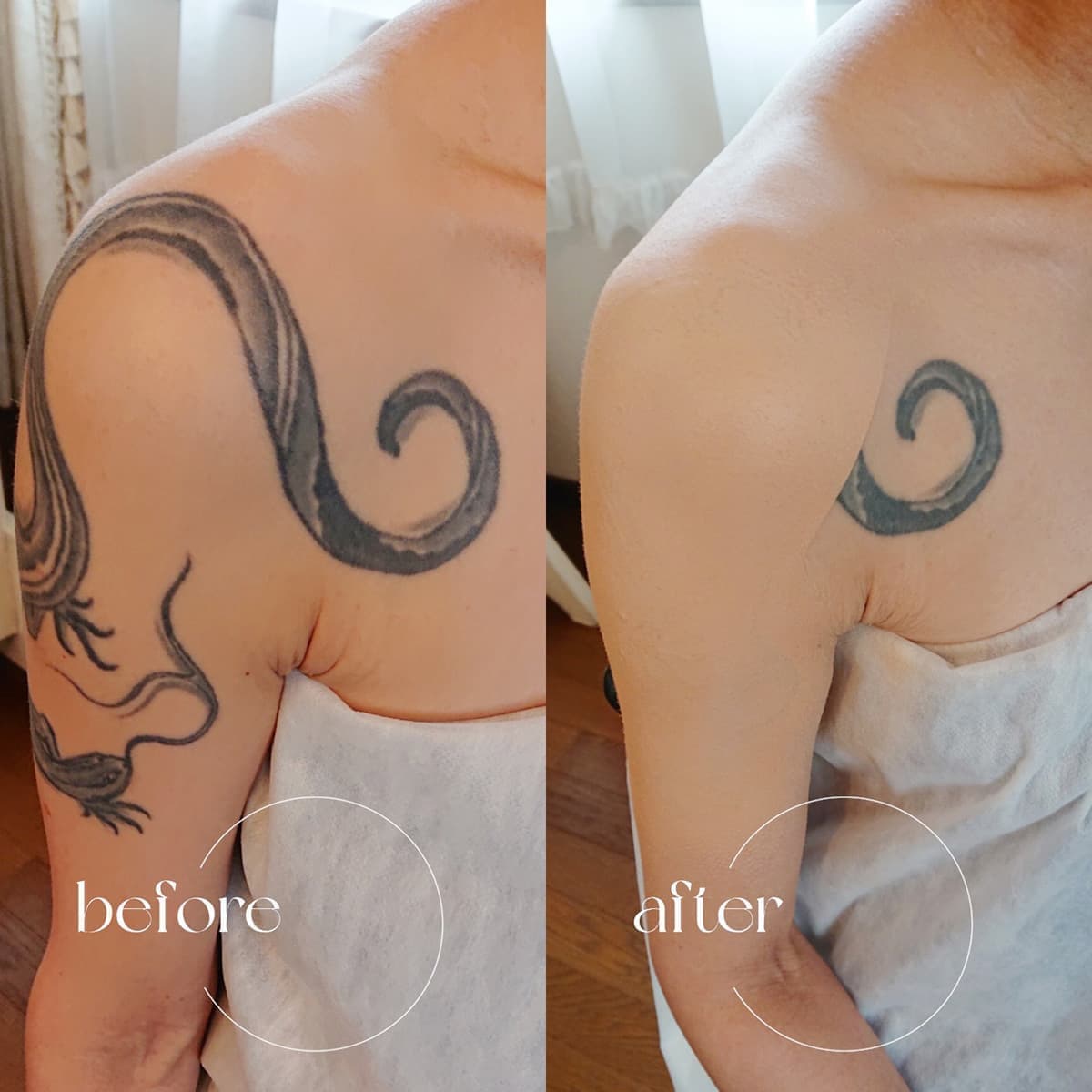ウエディングドレスを着ると露出する肩から胸にかけてのタトゥ※Afterは施術中の写真になります